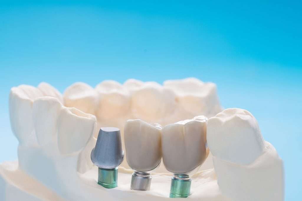 Dental-Bridges-thumb