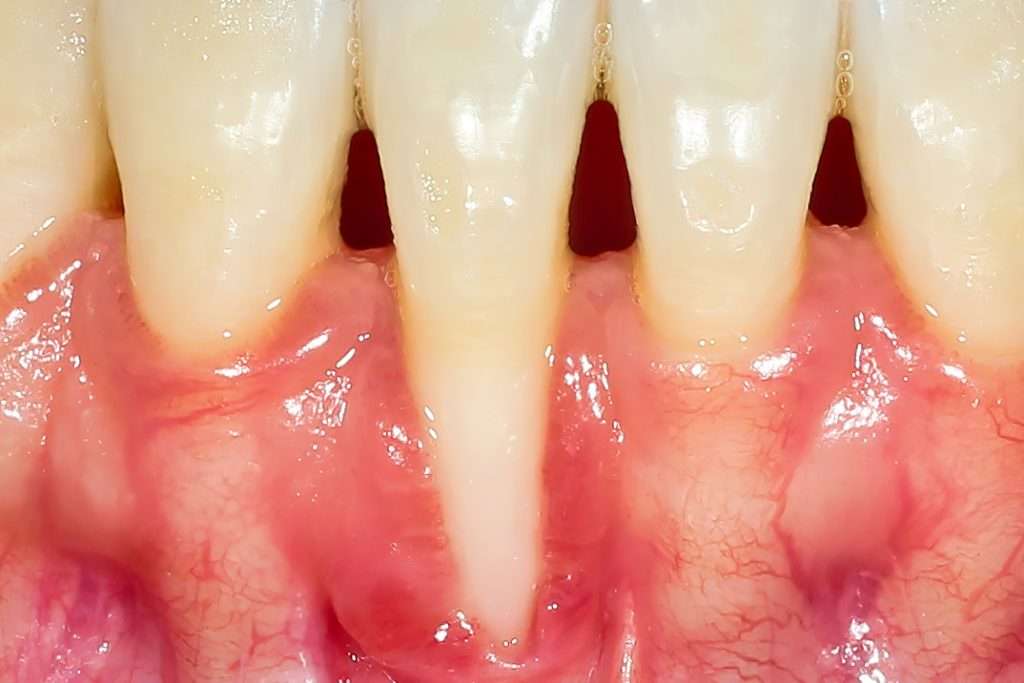Tooth Gum Injuries