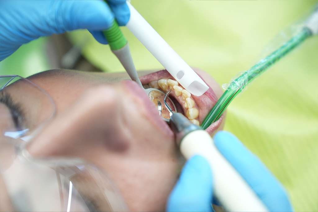 Gum Treatments-Deep Cleaning