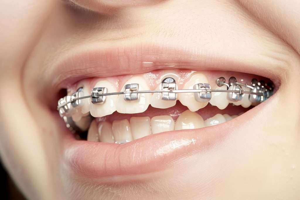 Metal-Braces