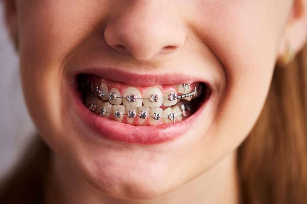 tooth braces in sharjah