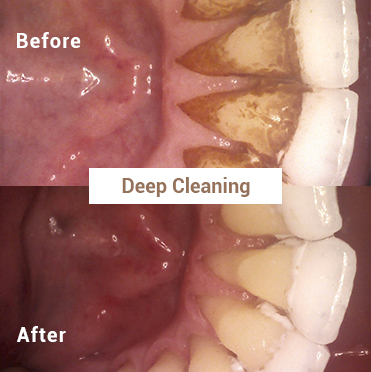 Deep Cleaning - Before & After (1)