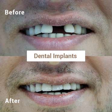 Dental Implants 1
