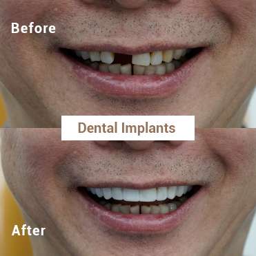 Dental Implants 2