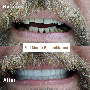 Full Mouth Rehabilitation 2