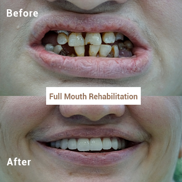 Full Mouth Rehabilitation