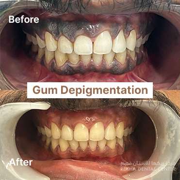 Gum-Depigmentation