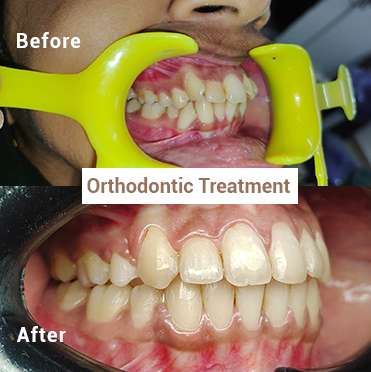Orthodontic Braces & Aligners - Before & After