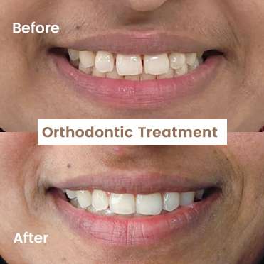 Orthodontic Treatment 1