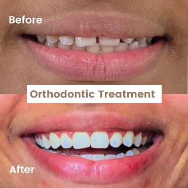 Orthodontic Treatment 2