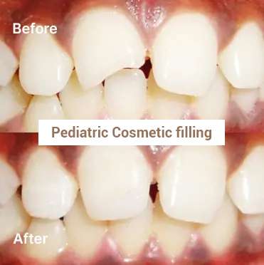 Pediatric Cosmetic filling - Before & After