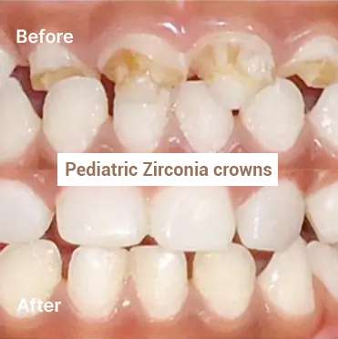 Pediatric Zirconia crowns - Before & After