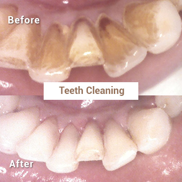 TEETH CLEANING 2