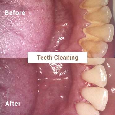 Teeth Cleaning - Before & After