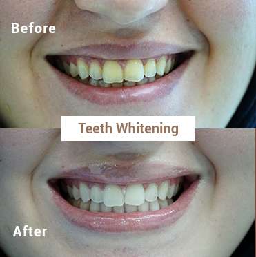Teeth Whitening 1