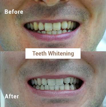 Teeth Whitening 2