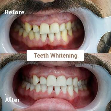 Teeth Whitening 3
