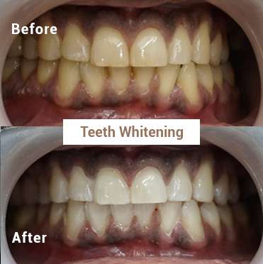 Teeth Whitening 4