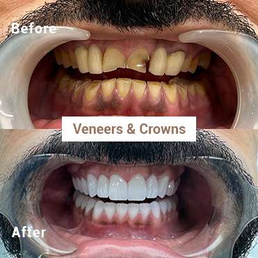 Veneers & Crowns - Before & After