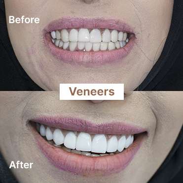 veneers-1