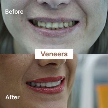 veneers-2
