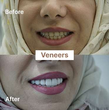 veneers-3
