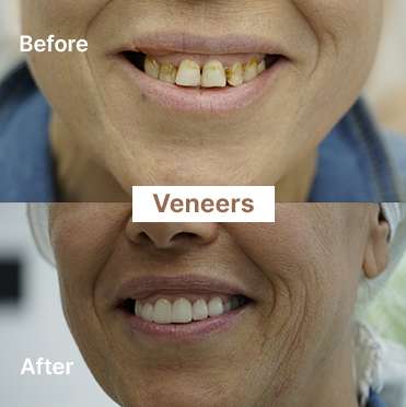 veneers-4