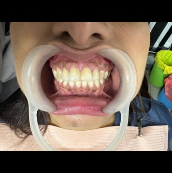 before-after- Veneers 1