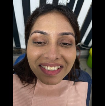 before-after-Veneers 2